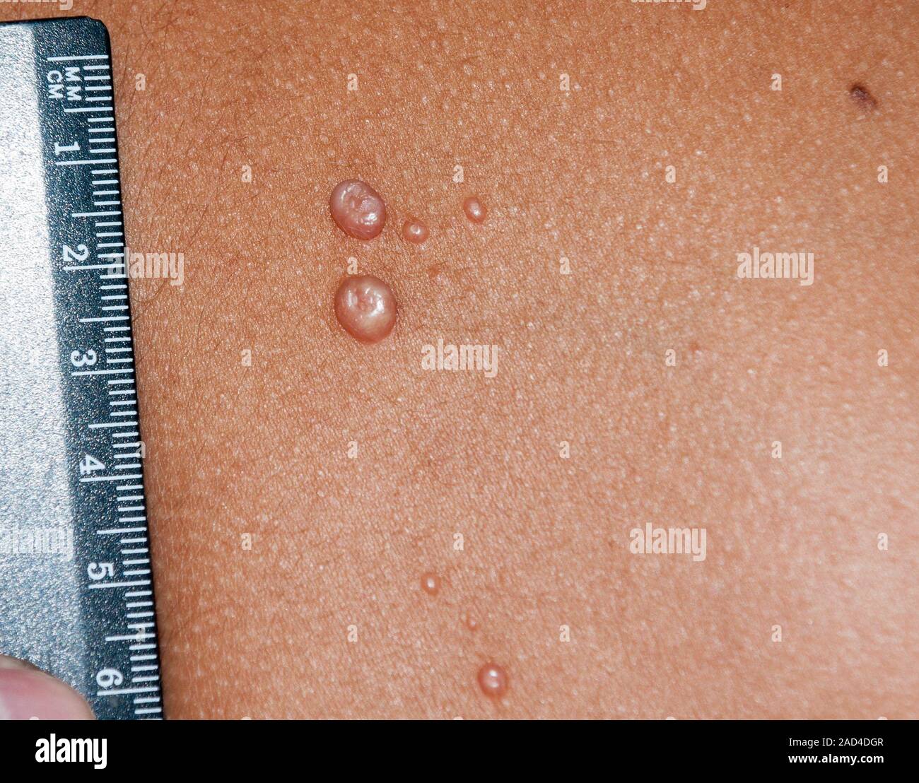 Molluscum Contagiosum Papules On The Skin Of An 8 Year Old Boy This