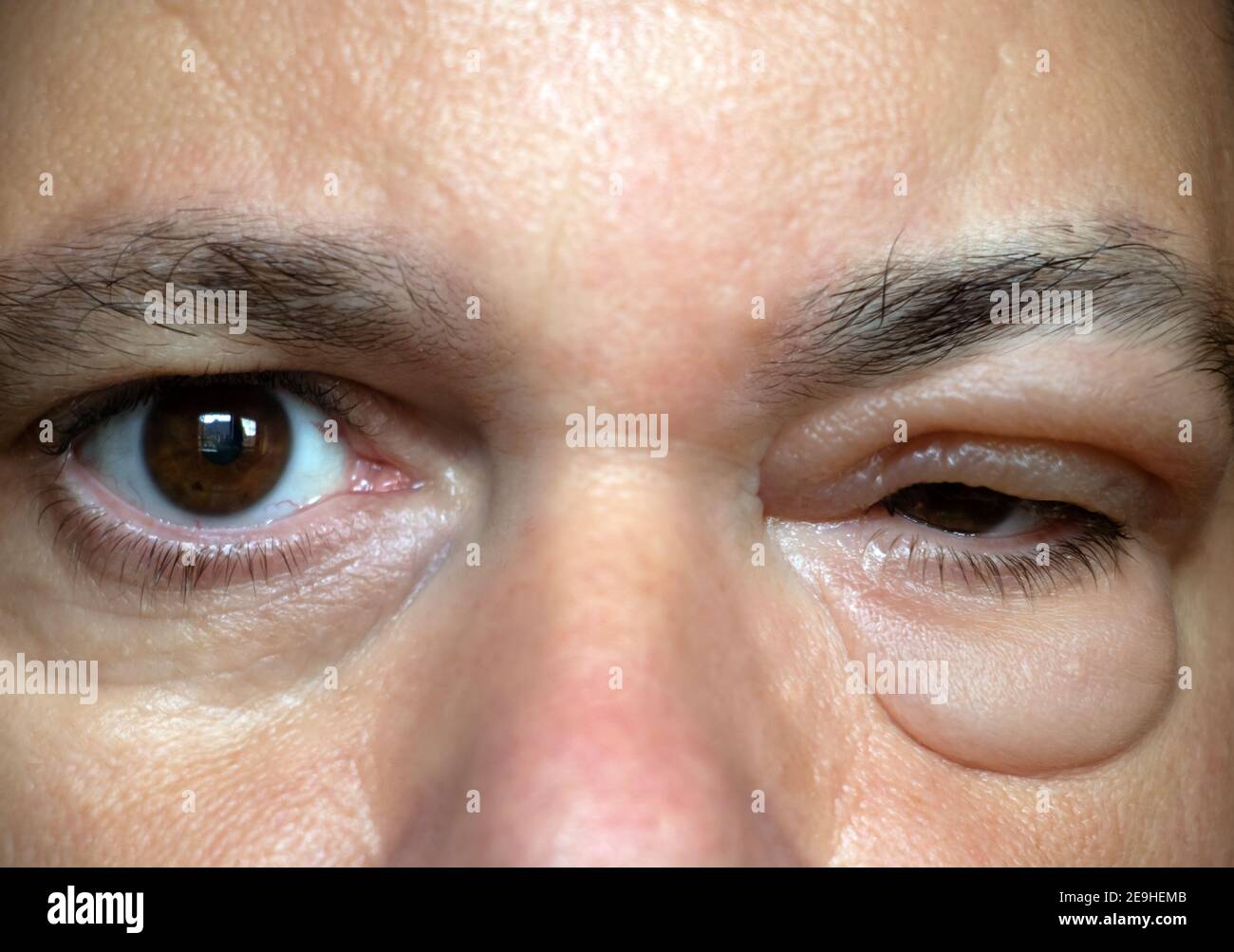 The Inflammation Of The Eyelid Swelling Of The Eye After Insect Bite A Man With Sick Eyes 