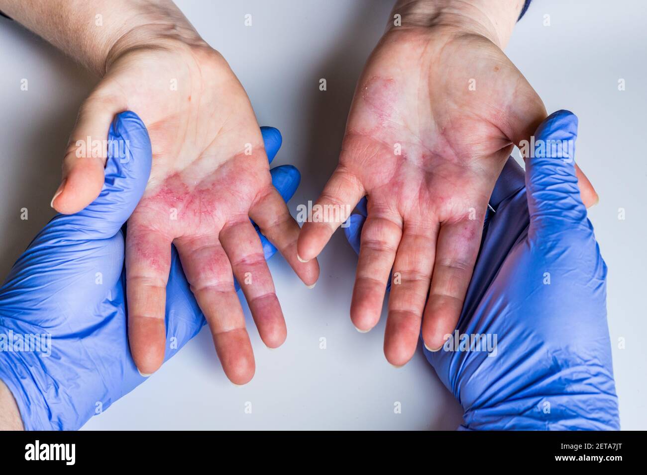 Atopic Dermatitis Red Itchy Hands With Blisters Seen By A 