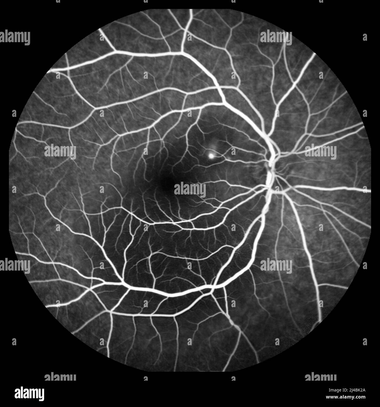 Central serous retinopathy, angiogram Stock Photo - Alamy