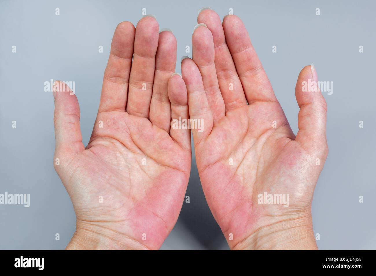 Bilateral palmar erythema (PE). Red hands palm Stock Photo - Alamy