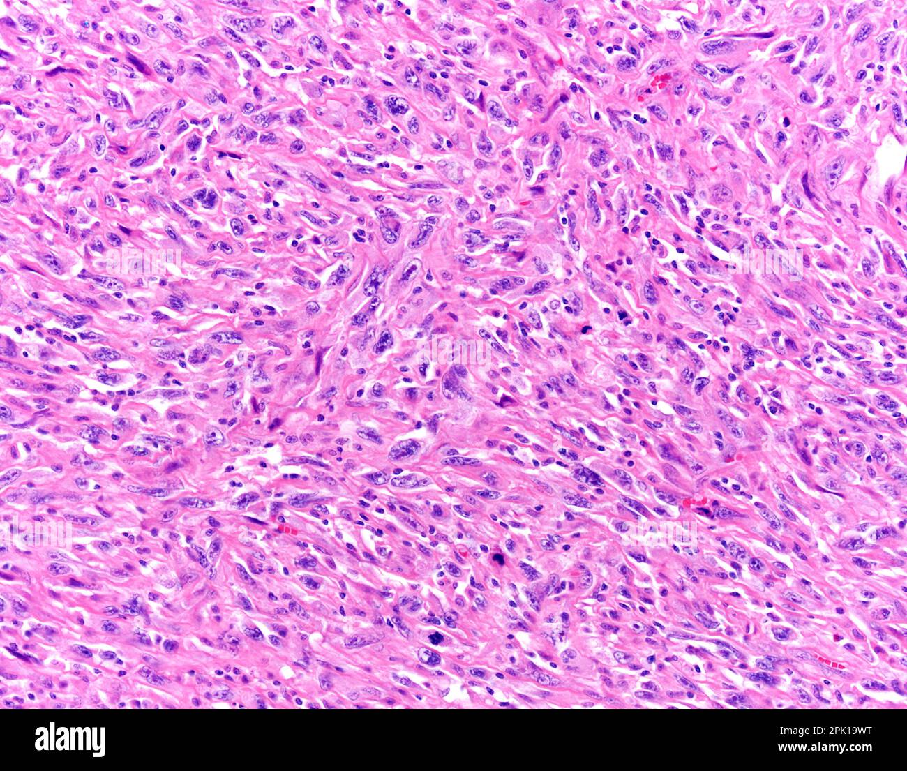 Pulmonary vein leiomyosarcoma, light micrograph Stock Photo - Alamy