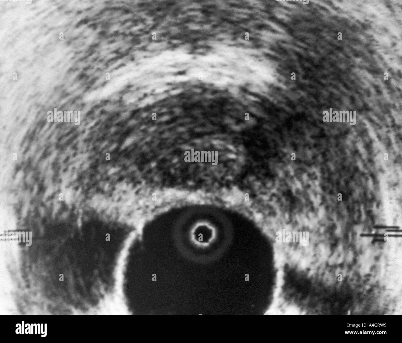 A Transrectal Ultrasound Scan Trus Of The Prostate Showing Cancer Of