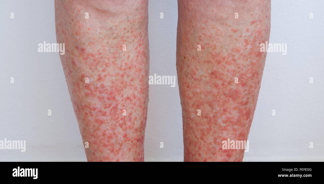 Womans Lower Legs Exhibiting The Itchy Rash Associated With A Severe Case Of Polymorphic Light 