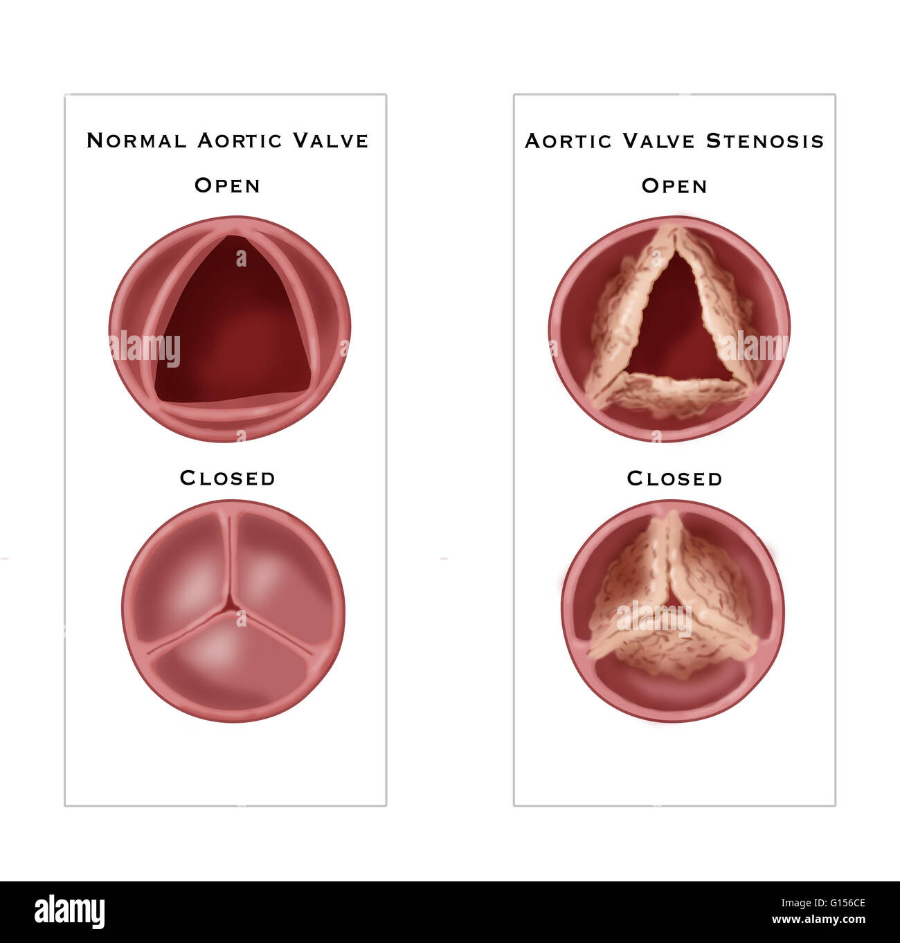 Illustration Comparing A Normal Aortic Valve Left To Aortic Valve