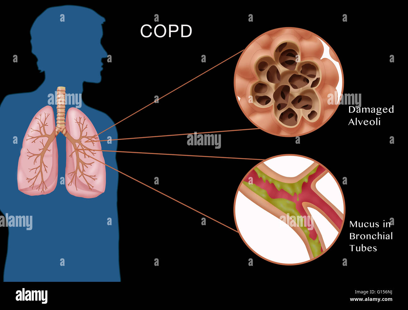 Illustration Of Chronic Obstructive Pulmonary Disease Copd A Common