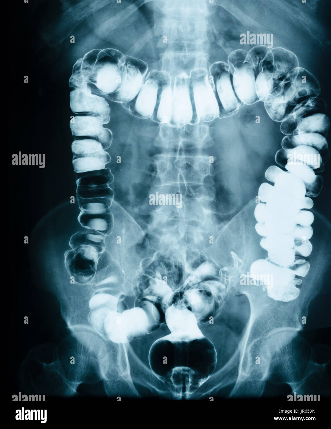 Small Intestine Obstruction Film X Ray Abdomen Supine Stock Photo Alamy