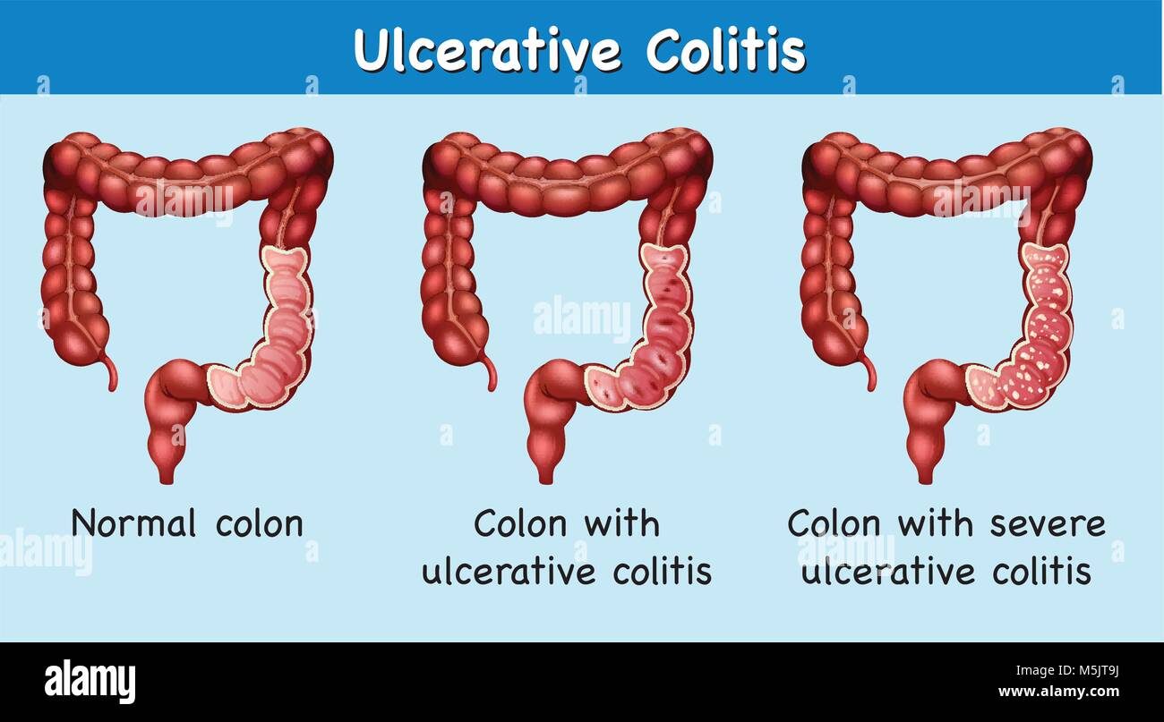 Diagram Showing Ulcerative Colitis Illustration Stock Vector Image And Art Alamy 