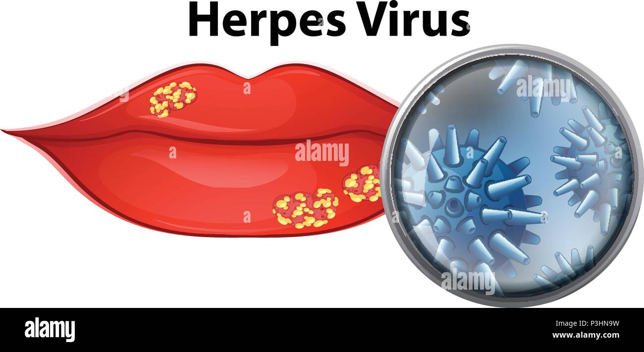 A Lip With Herpes Virus Illustration Stock Vector Image And Art Alamy