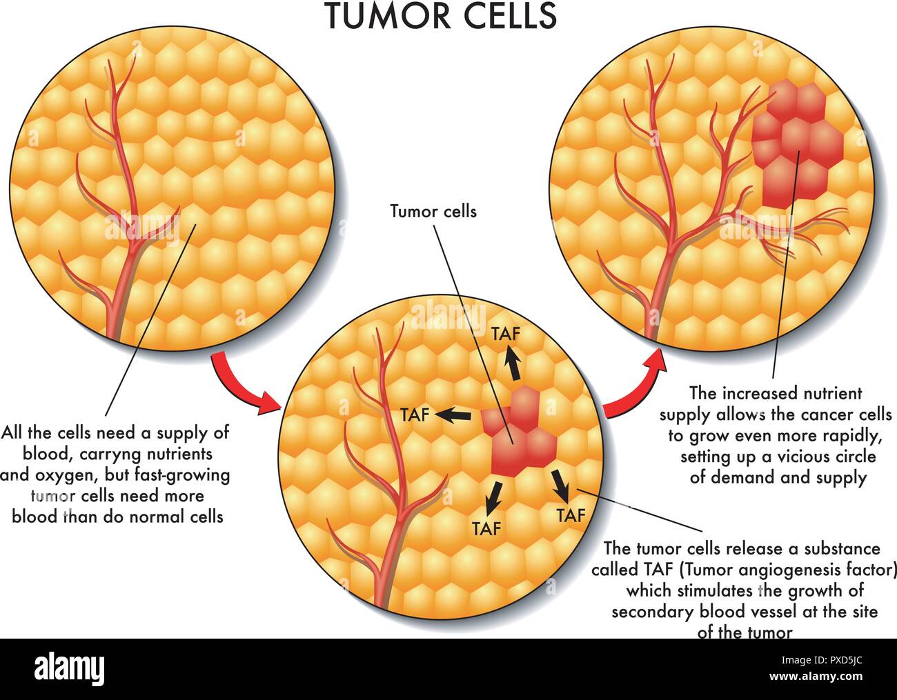 Vector Medical Illustration Of The Formation Of Tumor Cells Stock Vector Image And Art Alamy